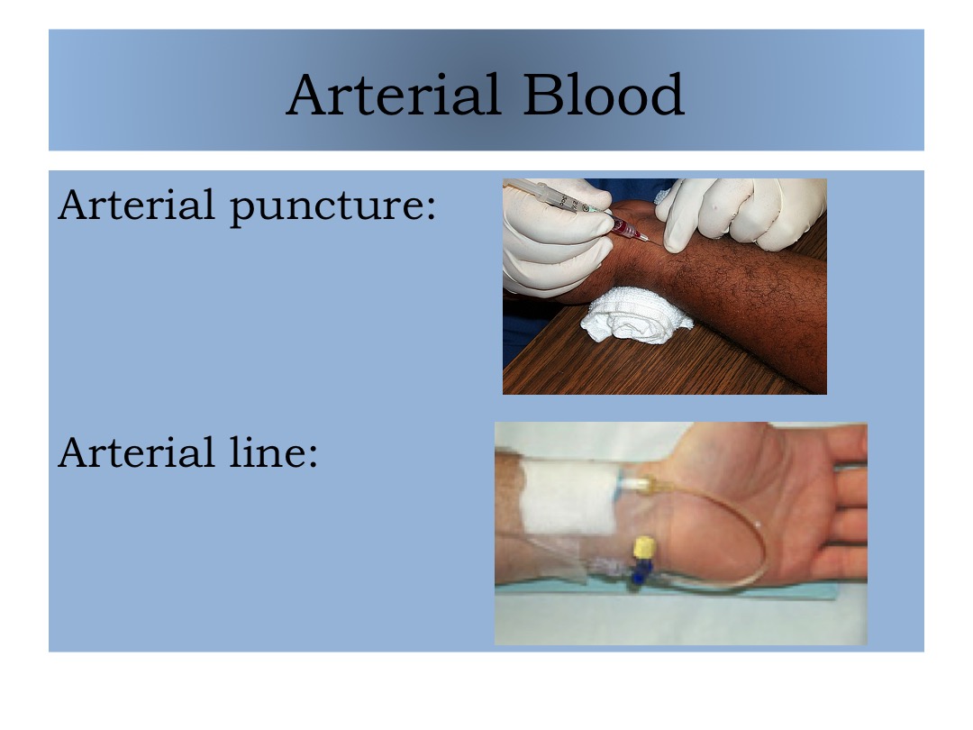 Arterial Puncture