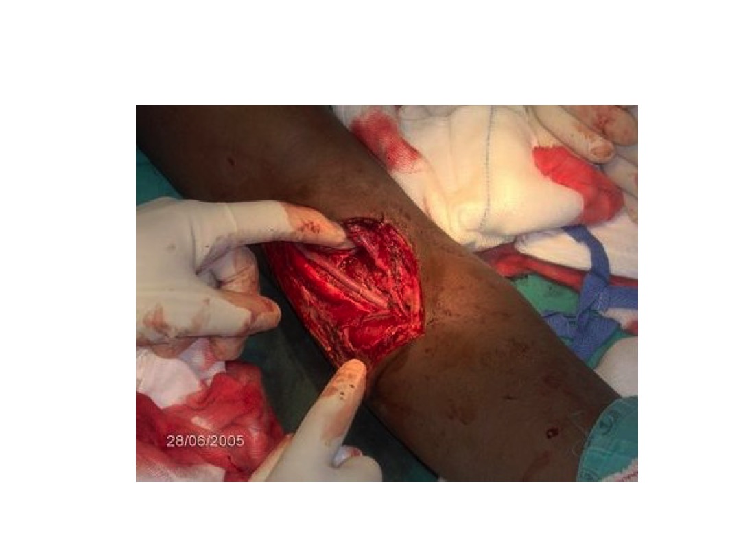 Brachial Artery slide image #2